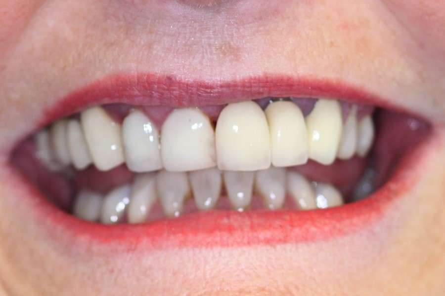 Best Dentures To Get Cochrane WI 54622